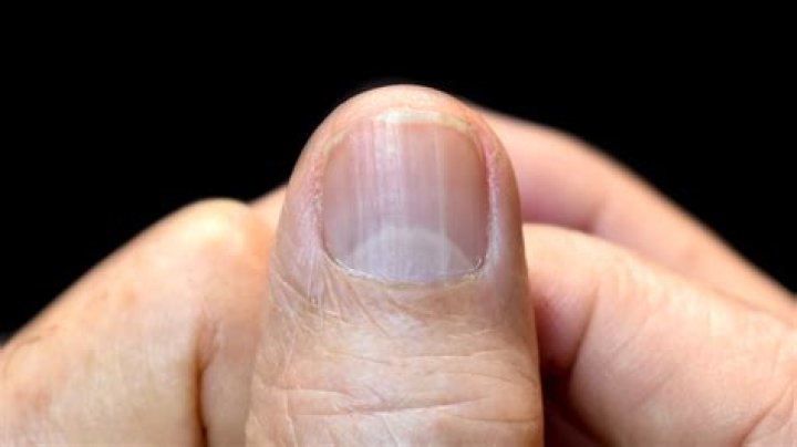 What causes fingernails to curve down