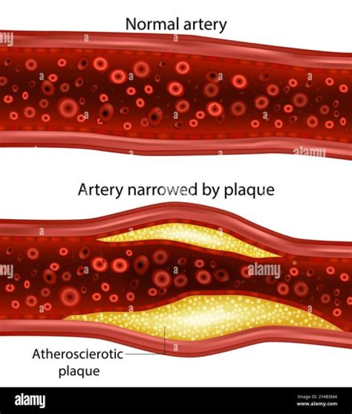 What makes an atherosclerotic plaque stable